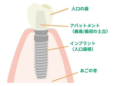 インプラント